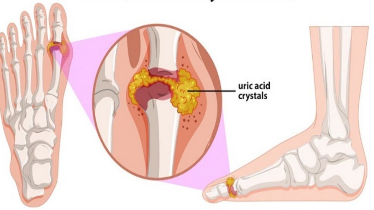 cumin water for kidney stones