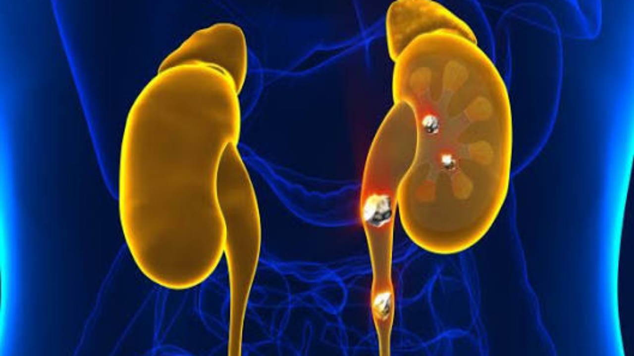 cumin water for kidney stones