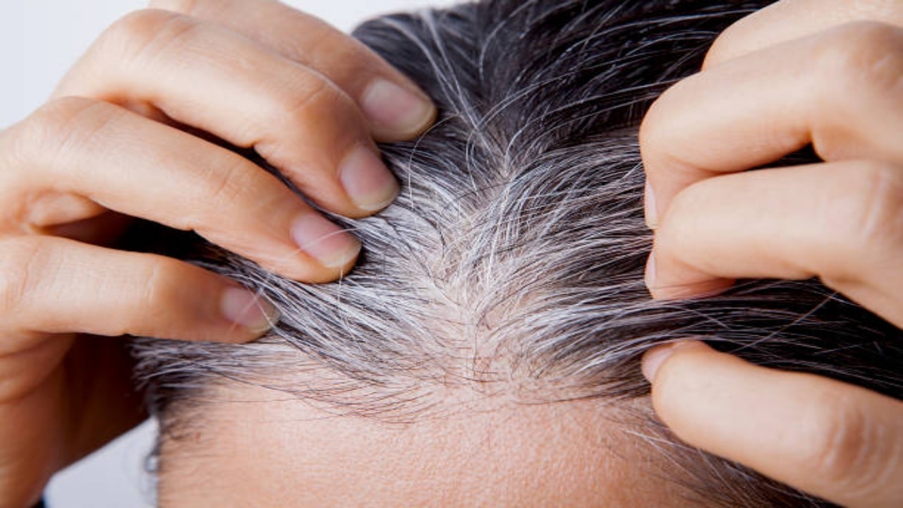 White Hair Home Remedies